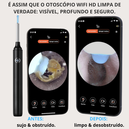 Otoscópio WiFi HD MILUNA-Pro